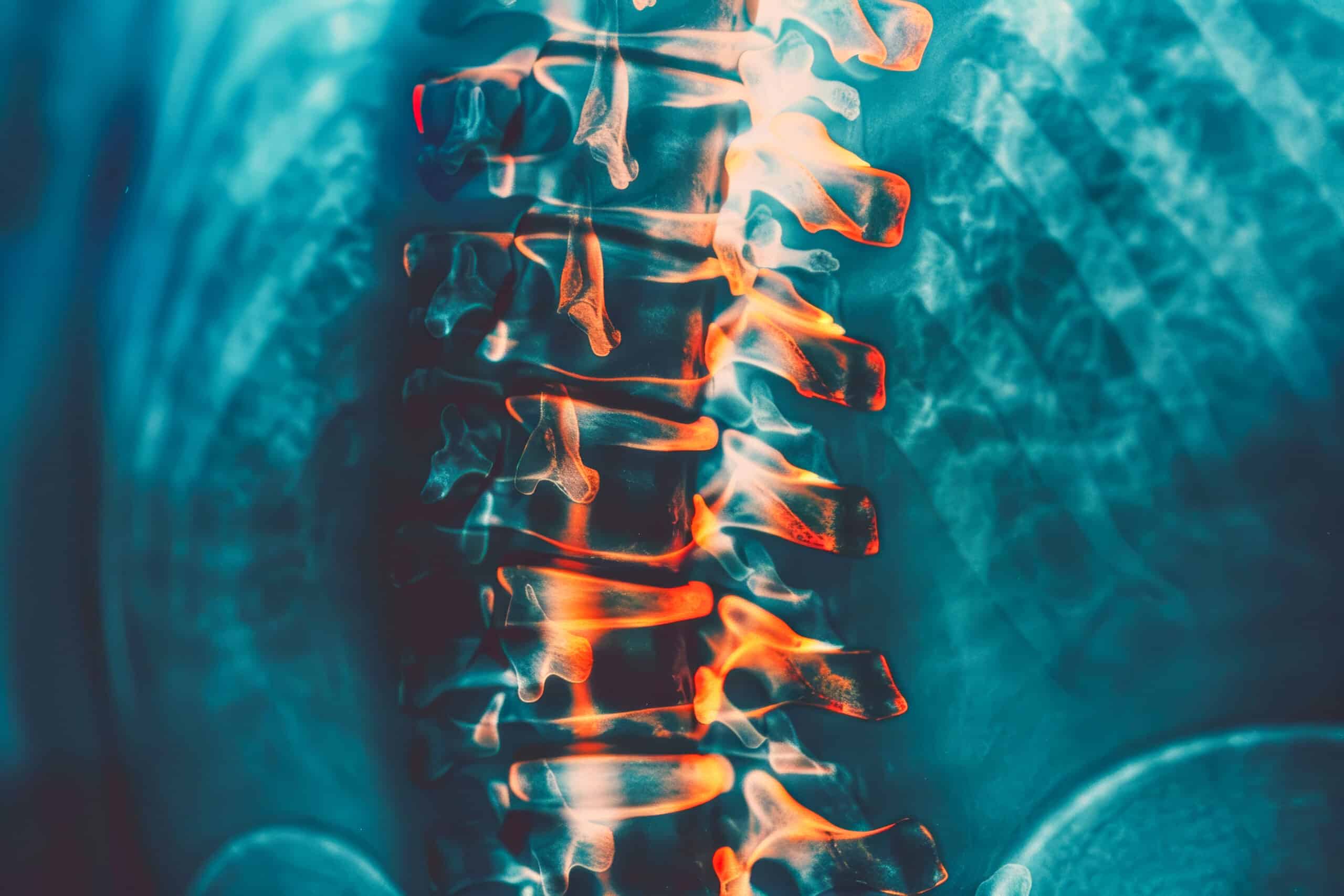 Lesión medular y cannabis medicinal